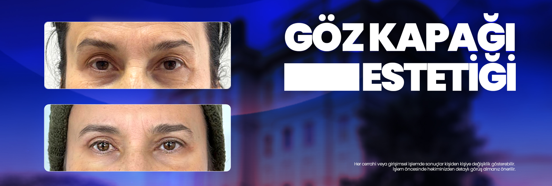 Before-and-after close-ups of a woman's eyes showing eyelid surgery results against a blue background.